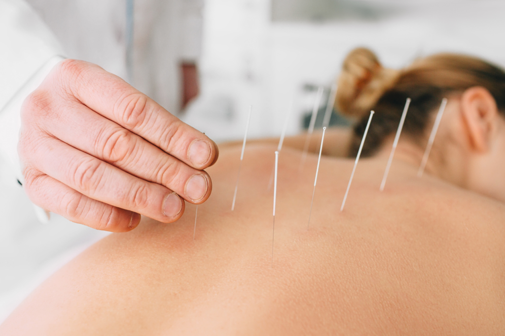 Acupuncture in Oceanside, NY